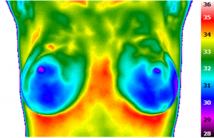 Infrarotthermographie einer gesunden Brust nach Abkühlung