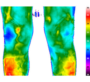 Infrarotaufnahme eines Patienten mit Reizknie (links) und Krampfadern (rechts)